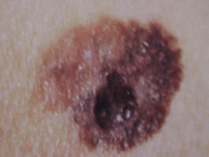 A túlzott napozás veszélyei – érdemes figyelni