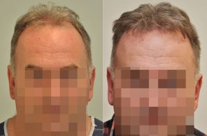 A hajbeültetés a megoldás a kopaszságra